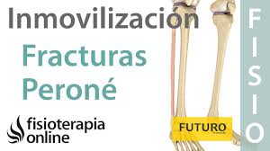 Fracturas De Perone Que Es Causas Sintomas Tratamiento Y Consejos Fisioonline