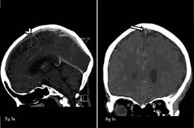 See that article for a discussion of that specific clinical entity. Superior Sagittal Sinus Thrombosis Figure 3a Ctv In Reformatted Download Scientific Diagram