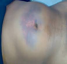 Parietal Swelling With Bruising After Motor Vehicle Accident Download Scientific Diagram