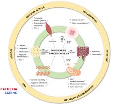 Image result for Cachexia in Cancer