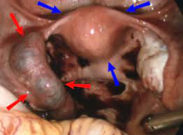 This is what prompt me to go to doctors and found out i was pregnant. Ectopic Pregnancy Wikipedia