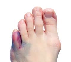 Maybe you would like to learn more about one of these? Bunion Treatment Options Before Surgery At Posture Podiatry