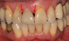 You might require scaling to get rid of the gum disease. How To Cure Gum Disease Without A Dentist Quora