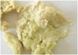 Image result for acholic stools human