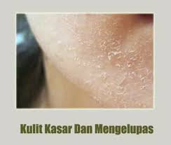 Artikel ini akan menerangkan punca dan rawatan yang mudah bagi masalah kulit mengelupas. Penyebab Kulit Wajah Kasar Griya Herbal Sehat Sejahtera Facebook