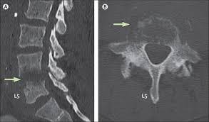 Image result for Osteomyelitis