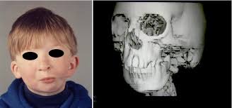Craniofacial disorders