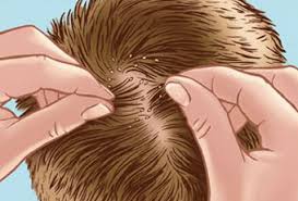 Top natural cures for lice. Top 5 Simplest Natural Ways To Get Rid Of Head Lice Eggs And Nits Holistic Healing Natural
