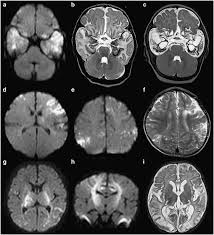 • restriction on diffusion weight mri = more sensitive than conventional sequences. Predominant Area Of Brain Lesions In Neonates With Herpes Simplex Encephalitis Journal Of Perinatology