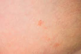 The rash begins with a herald patch and continues to spread in a characteristic pattern, typically over the course of six to eight weeks. Hautausschlage Hautkrankheit Pityriasis Rosea Close Up Lizenzfreie Fotos Bilder Und Stock Fotografie Image 74513448