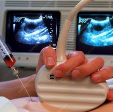 Image result for Chorionic Villus Sampling