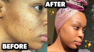 To treat your dark spots with papaya, simply mash ripe papaya in a bowl and apply as a mask to clean skin. Affordable Skincare Routine For Acne Dark Marks Hyperpigmentation Youtube