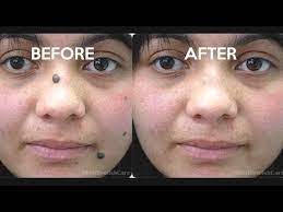 Let it remain on the face for hours. 2 Easy Ways To Remove Moles From Your Face How To Get Rid Of Moles Youtube Moles On Face Remove Mole How To Get Rid Of Moles