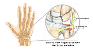 Image result for TFCC Steroid Injection