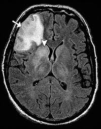 For a general discussion, and for links to other system specific manifestations, please refer to the article on hydatid disease. Rabies Encephalitis Airp Best Cases In Radiologic Pathologic Correlation Radiographics