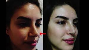 Deniz Baysal Burun Estetigi Youtube