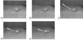 How long until i can change my belly button ring? Temporary Removal Of Navel Piercing Jewelry For Surgery And Imaging Studies American Academy Of Pediatrics