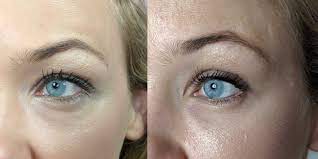 Augenringe Unterspritzen Tschuss Augenschatten Brigitte De