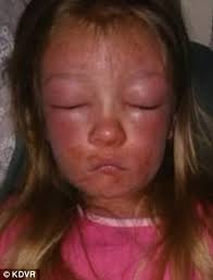 Giật mình với gương mặt biến dạng nặng nề sau khi đi tắm biển của bé 6 tuổi