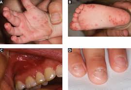 Image result for Hand foot and mouth disease HFMD roof of mouth