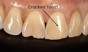 Image result for Tooth Fracture