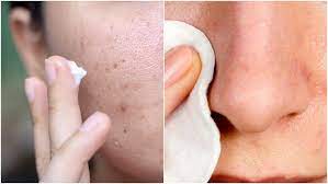 Kalau pakaian yang tritipan berwarna putih, kamu bisa hilangkan noda bintik hitamnya dengan pemutih pakaian. Cara Menghilangkan Komedo Yang Membandel Di Hidung Hingga Pipi Baik Yang Hitam Maupun Putih