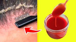 как избавится от перхоти в домашних условиях за 1 день Kak Izbavitsya Ot Perhoti Za 3 Dnya V Domashnih Usloviyah Youtube