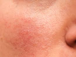 Medizinisch heißt der hautausschlag exanthem. Rosacea Symptome Behandlung