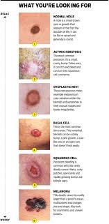 23.04.2018 · skin cancer can present in a range of ways. Basal Cell Carcinoma