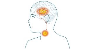 What are the symptoms of a stroke? Stroke A Disease For All People Of All Ages Iqoro
