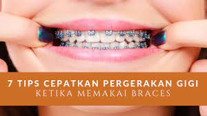 Kerusakan gigi atau gigi berlubang bisa membuat anda sakit gigi. Nad S Braces Journey 7 Tips Cepatkan Pergerakan Gigi Ketika Memakai Braces Pengedar Shaklee Kedai Vitamin Bandar Baru Bangi