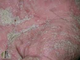 Image result for scabies in the groin area