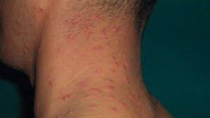 Image result for Papular urticaria