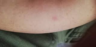 Ist Der Zeckenbiss Gefahrlich Gesundheit Und Medizin Zecken Borreliose