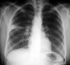 Fd Subsegmental Atelectasis Radiology Neurofibromatosis Type 1 Radiology Imaging