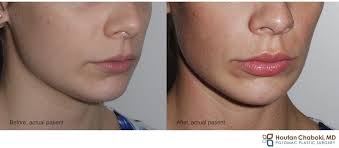 Check spelling or type a new query. 10 Things To Know Before Getting Lip Injections