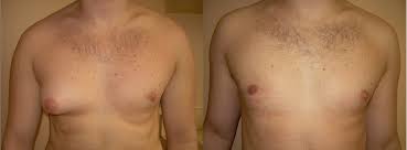Doctor prices for breast reduction cosmetic surgery in 2013: Gynecomastia Surgery Miami Avana Plastic Surgery