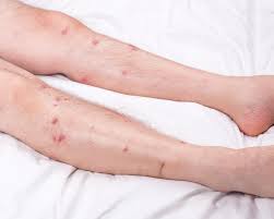 Image result for Skin Ulcer