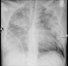 As said, legionella pneumonia has a more appropriate name in medical science, and that is known as legionnaires'. Legionella Pneumonia Radiology Case Radiopaedia Org