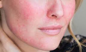 We did not find results for: Let S Say Goodbye To Broken Capillaries For Good Select Skin