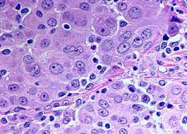 Maybe you would like to learn more about one of these? Mesothelioma Oncology Medbullets Step 2 3