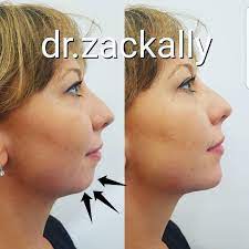 Chin Augmentation Weak Chin High Density Dermal Filler Has The Ability To Enhance And Balanc Chin Augmentation Dermal Fillers Chin Filler