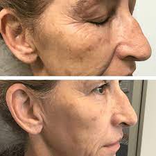 Factor 4 Anti Ageing Brisbane - Ascension Cosmetic Medicine