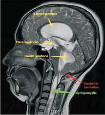 Image result for Syringomyelia