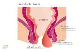 Hamorrhoiden Symptome Behandlung Vorbeugen Onmeda De