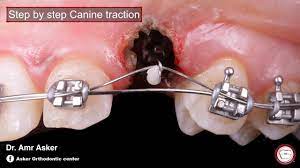 Dr vanarsdall recommends open exposure with a repositioned gingival flap (pediculated connective tissue graft) above the impacted canine. Step By Step Surgical Exposure And Orthodontic Traction Of Impacted Canine By Amr Asker Youtube