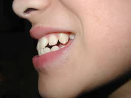 Treatment time depends on your specific condition. How To Tell If You Have An Overbite How To Tell If