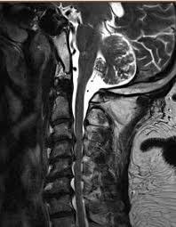 When that happens, the brain sends a signal that causes pain, weakness, or a numb feeling. Cervical Spine Anatomy Diseases And Treatments