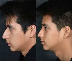 Popular Cosmetic Surgery For British Men Desiblitz Cosmetic Surgery Rhinoplasty Rhinoplasty Nose Jobs