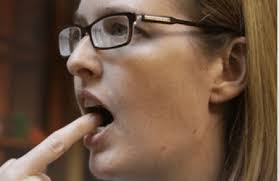 Limited Mouth Opening Problems